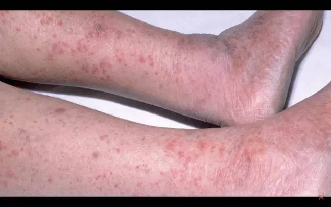 他的皮肤开始出现皮疹。学分：新英格兰医学杂志 / YouTube /@chubbyemu