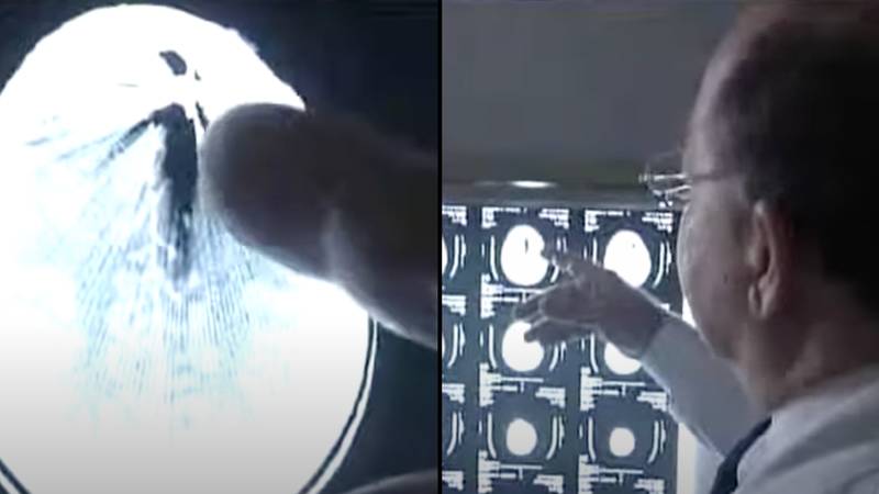 医生显示罕见的大脑X射线图像显示枪伤对头部的影响