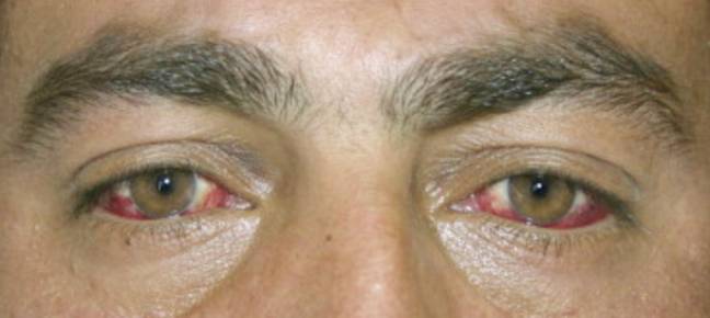 感染CCHF的患者。学分：美国眼科杂志