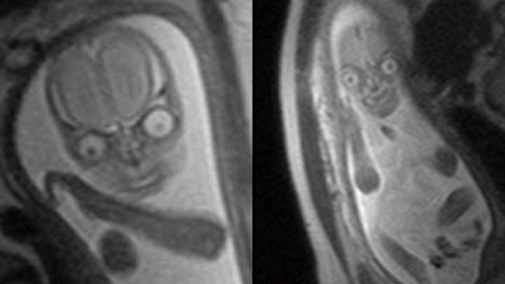 人们看到子宫内的婴儿的MRI图像后感到恐惧