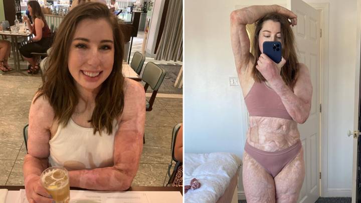Woman with 96% body burns was given one in thousand chance of