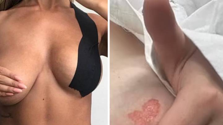 Booby Tape: Shocking claims of torn skin and injuries from product made by  Roccisano sisters