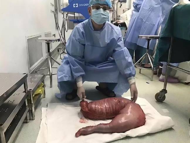 Surgeons removed 30 inches of the man's colon. Credit: Shanghai Tenth People's Hospital