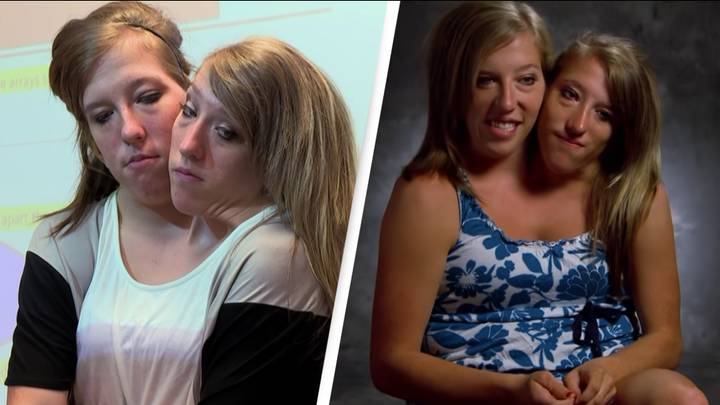 Conjoined twins opened up on what their life was like after becoming ...