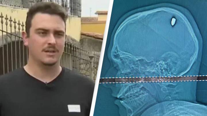 Man continues to party for four days without realising he had been shot in the head leaving a bullet lodged�in�his�brain (Photos)