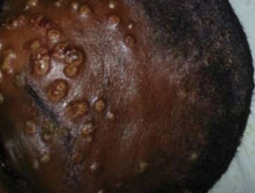Monkeypox属于与天花的同一病毒家族，但会引起温和的感染。学分：CDC/新兴传染病