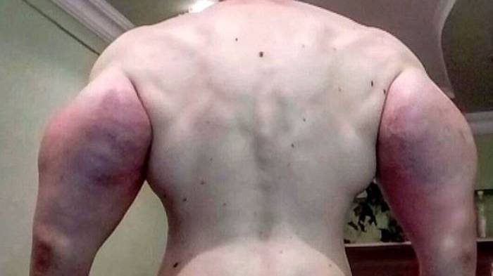 The Weird World of Synthol Bodybuilders