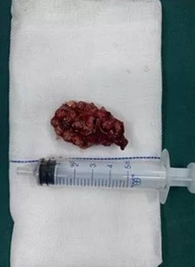Boy gets 31 magnetic balls lodged in his bladder after shoving them up his  penis – The US Sun