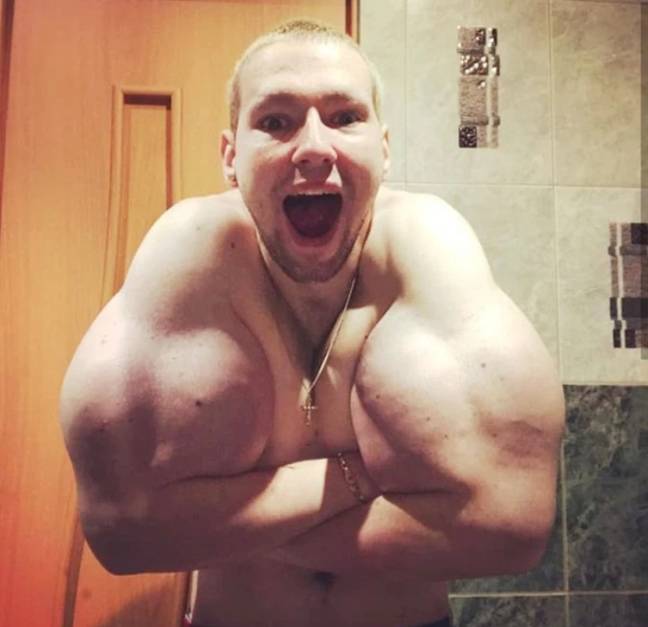 MMA Fighter Undergoes Surgery To Remove Six Litres Of Synthol He Used To  Pump Up His Biceps - SPORTbible