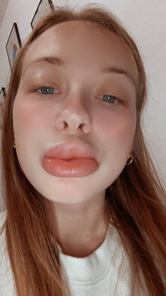 Woman's Lips Triple In Size After Botched £80 Fillers