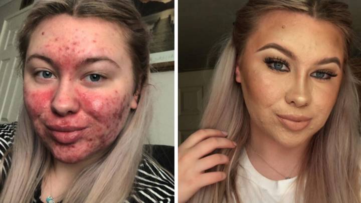 Acne Sufferer Refuses To Date As She Fears Men Will Accuse Her Of