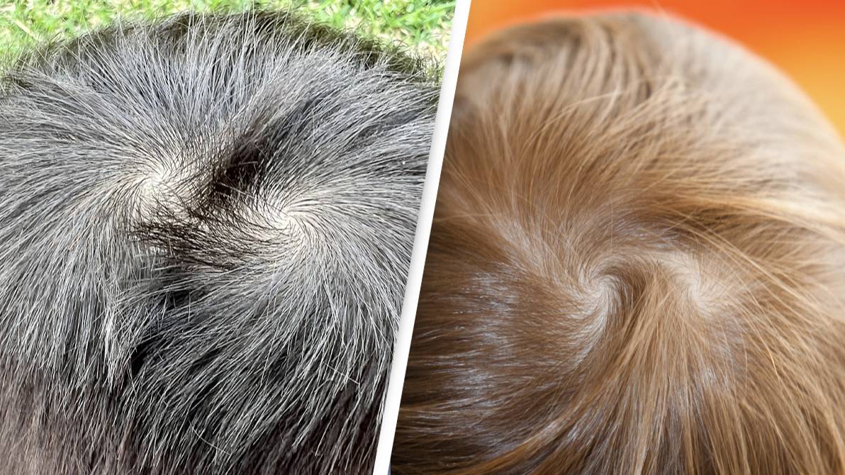 Only 5 In 100 People Have A Very Rare Double Hair Whorl only-5-in-100-people-have-a-very-rare-double-hair-whorl