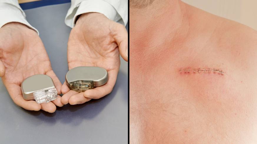 Researchers Develop Technology To Charge Implants Such As Pacemaker ...