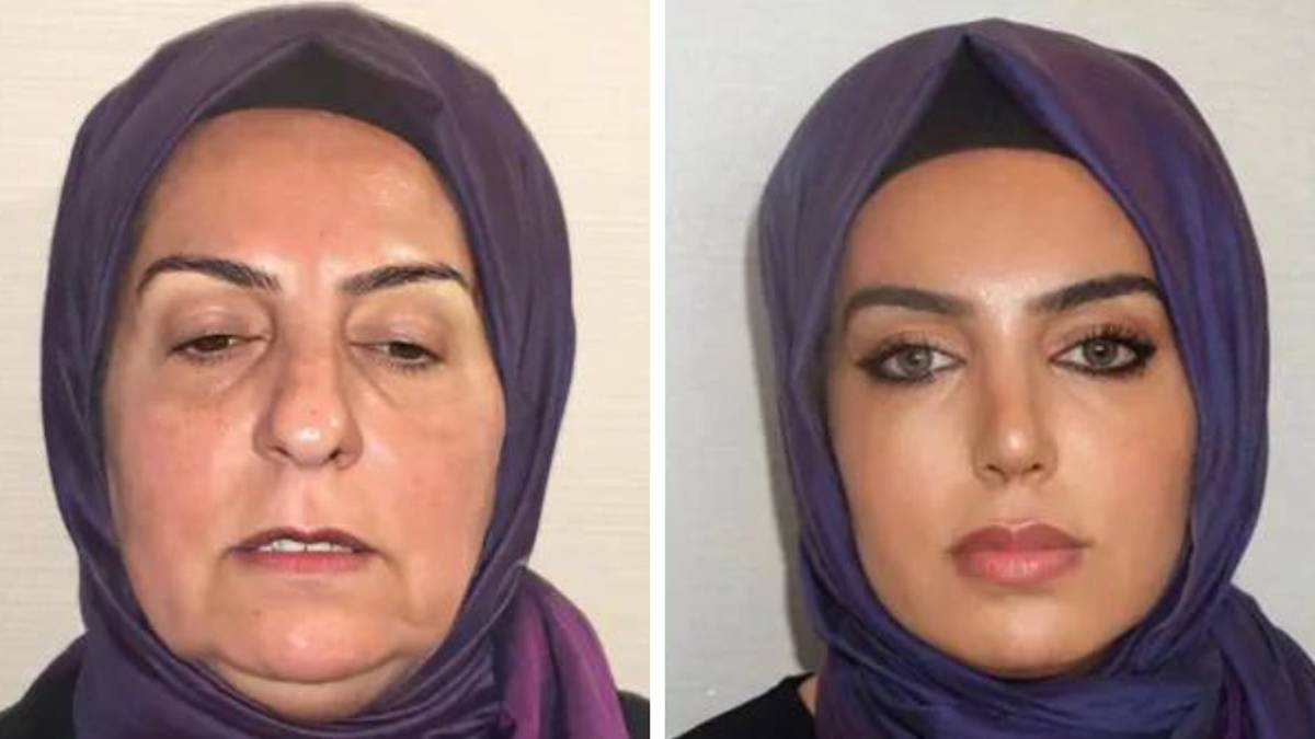 A 68yearold woman from Turkey shocks with before and after plastic A 68yearold woman from Turkey shocks with before and after plastic