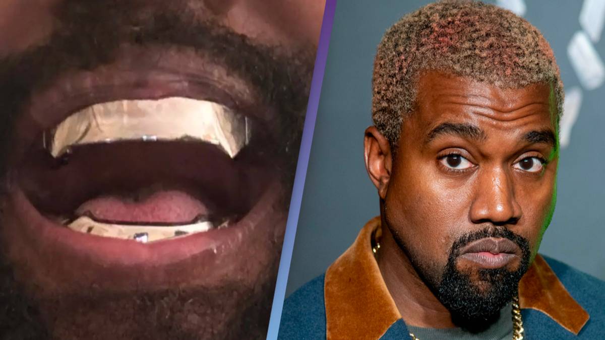 Kanye West’s 850,000 titanium teeth are ‘permanent’ and go ‘beyond