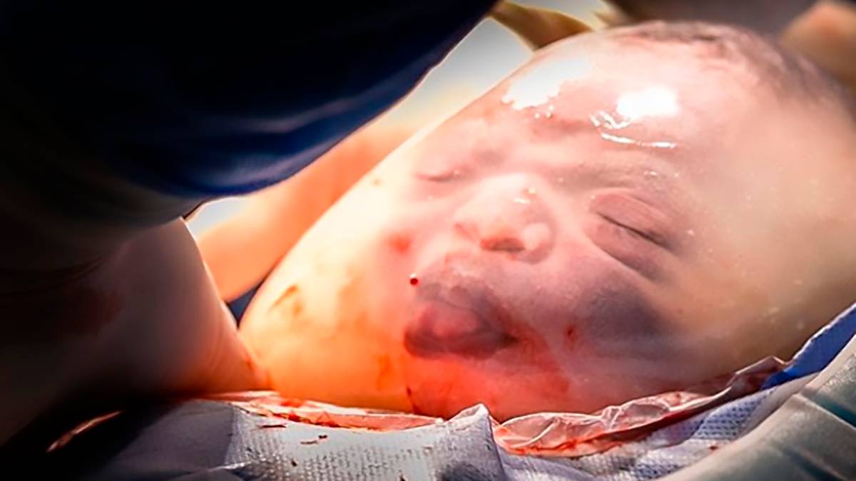 Incredible Images Show Baby Born Inside Amniotic Sac - Tyla