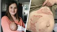 New Mum Discovers She's 'Allergic To Her Own Baby'