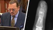 Surgeon Testifies That Depp's Severed Finger Story Is 'Inconsistent'