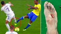 Cadiz Defender Shows Off Gruesome Gash And Broken Foot After Tackle From Eden Hazard