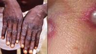 Should I Be Worried About Monkeypox And What Are The Symptoms?