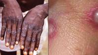 UK Government Orders Monkeypox Contacts To Self Isolate For Three Weeks As More Cases Confirmed