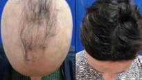 New Drugs Regrows Hair In 40% Of Patients