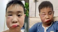 Boy's face swells up massively as he's attacked by swarm of bees after constantly poking their hive