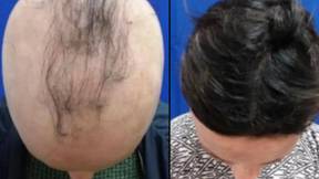 新药会在40％的患者中重新生长头发