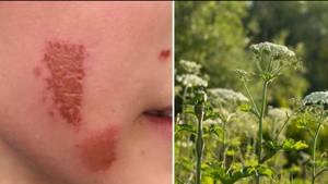 Mum's Warning After Dangerous Plant Leaves Son With Severe Burns