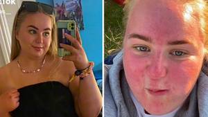 Woman Shares Warning After Suffering Blistering Sunburn From Just One Hour In UK Sun