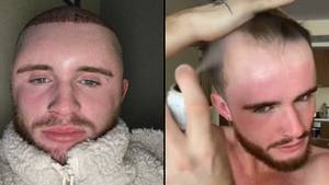 Guy Faces Month-Long Sex Ban To Protect Hair Transplant