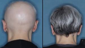 恢复许多患者头发生长的脱发药在美国获得批准