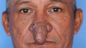 Man With Severe Deformity Gets New Nose After Chance Meeting With Surgeon
