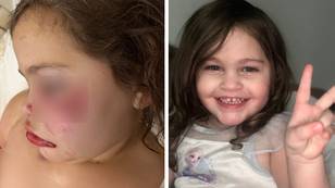 Little girl left missing half her smile after the family's rescue dog turned into a 'man-eater'