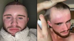 Guy Faces Month-Long Sex Ban To Protect Hair Transplant