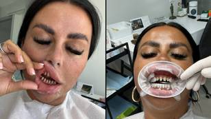 Woman says her £4000 ‘Turkey teeth’ ruined her life