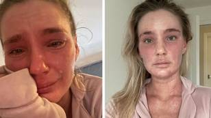 Woman 'burned by steroid cream' so badly she no longer recognises herself in the mirror