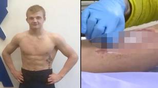 College wrestler nearly lost his leg after bruise turned out to be a flesh-eating infection