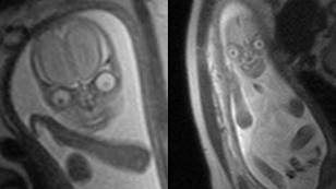 People are horrified after seeing MRI images of a baby inside the womb
