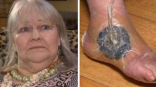Woman feared she would lose her leg after suffering from flesh-eating infection on foot