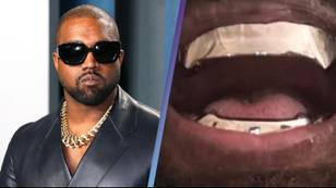 How Kanye West will clean his $850,000 titanium teeth