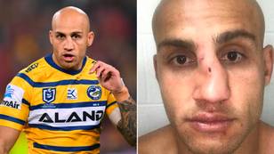 Ex-rugby league player calls out NRL for 'ruining my face'