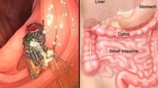 Doctors stunned after finding living fly inside man’s intestines