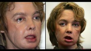 Woman who got world’s first face transplant suffered devastating consequences afterwards