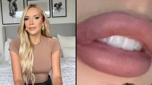 Love Island star admits she ruined her face with lip filler