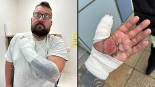 Bloke left with horrific injuries after vape battery blows up in his hand