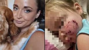 Mum decides to keep dog after it mauled three-year-old daughter's face leaving her scarred