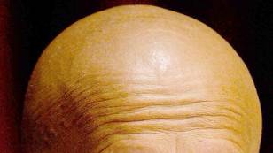 Scientists Think They've Found A Way To Cure Baldness