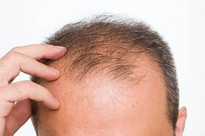 This Is Why You Lose Hair In Specific Areas On Your Head First, And Why You're Balding Prematurely 