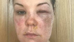 Mum Left With Burns To Face, Neck And Chest After Egg Poaching Hack